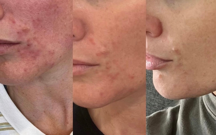 Pregnancy Bundle - Breakouts